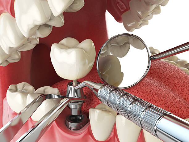 Best Emergency Broken Tooth Repair in Huron, OH